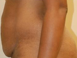 Mommy Makeover before and after - before