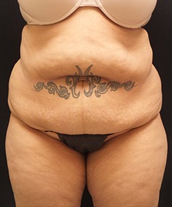 Mommy Makeover before and after - before