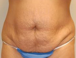 Mommy Makeover before and after - before