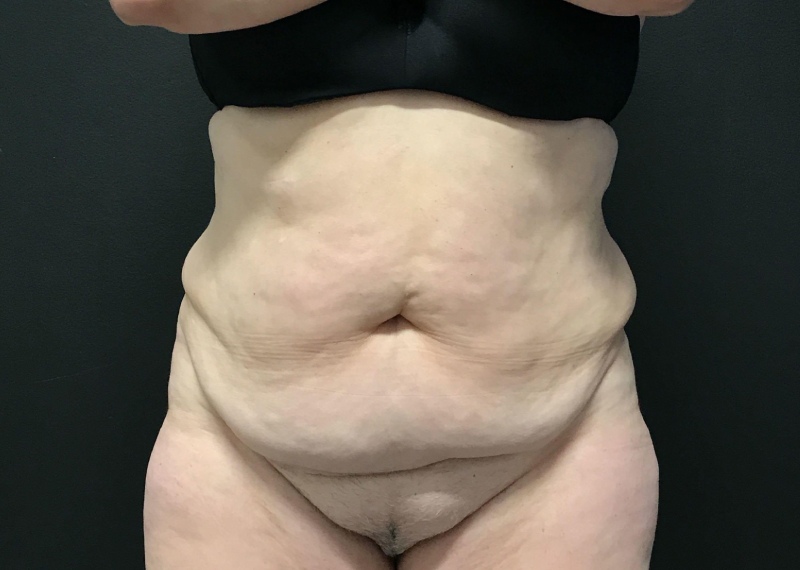 Mommy Makeover before and after - before