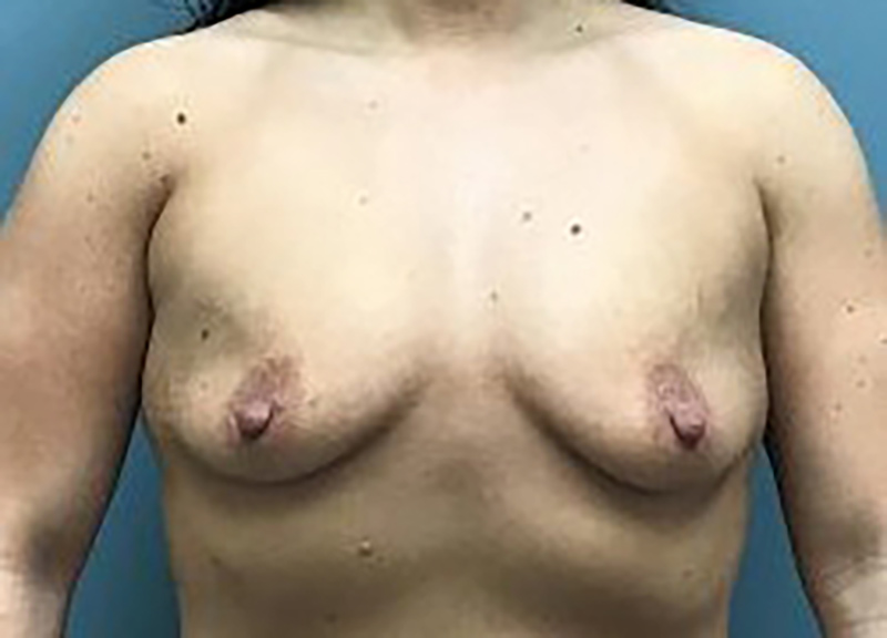 Breast Augmentation before and after - before