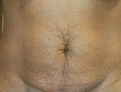 Mommy Makeover before and after - before
