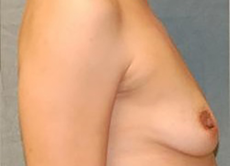 Breast Augmentation before and after - before