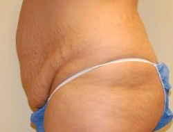 Mommy Makeover before and after - before