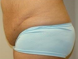Mommy Makeover before and after - before