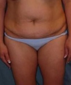 Mommy Makeover before and after - before