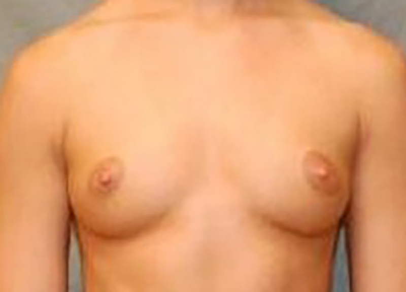 Breast Augmentation before and after - before