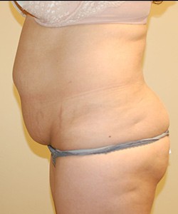 Mommy Makeover before and after - before