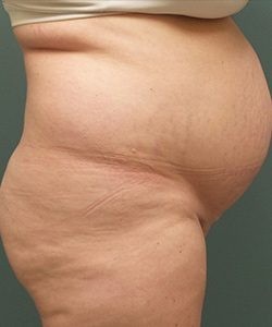 Mommy Makeover before and after - before