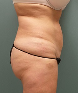 Mommy Makeover before and after - before