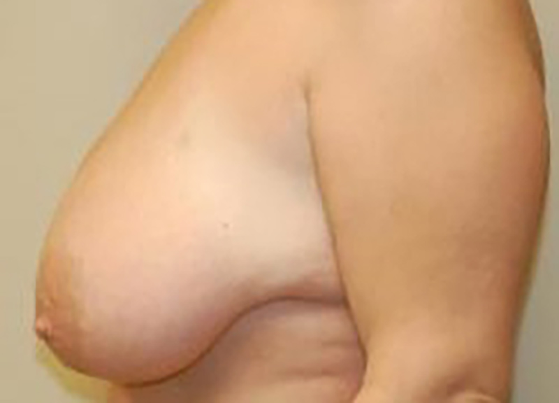 Breast Lift before and after - before