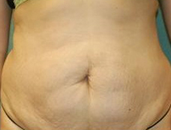 Mommy Makeover before and after - before