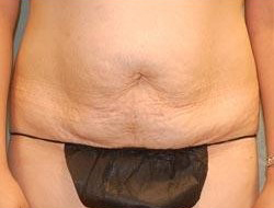 Mommy Makeover before and after - before