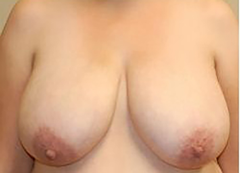 Breast Reduction before and after - before