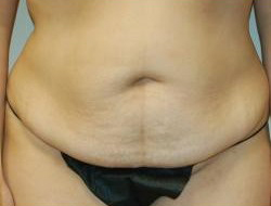 Mommy Makeover before and after - before