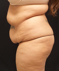 Mommy Makeover before and after - before