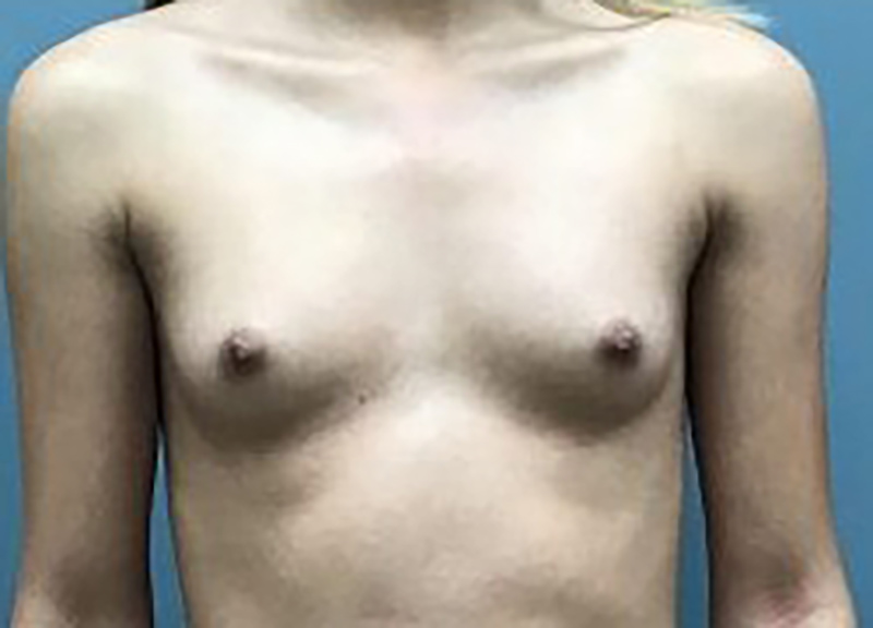 Breast Augmentation before and after - before