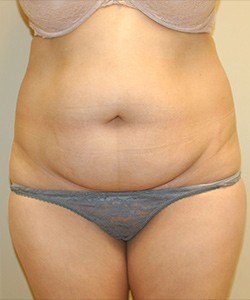Mommy Makeover before and after - before