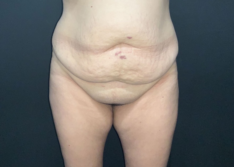 Mommy Makeover before and after - before