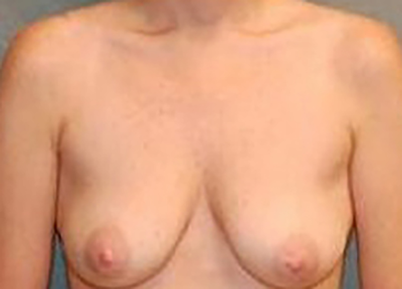 Breast Augmentation before and after - before