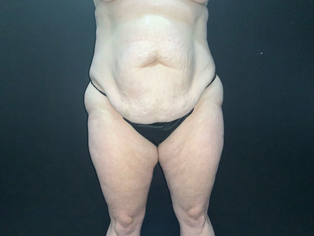 Mommy Makeover before and after - before