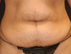 Mommy Makeover before and after - before
