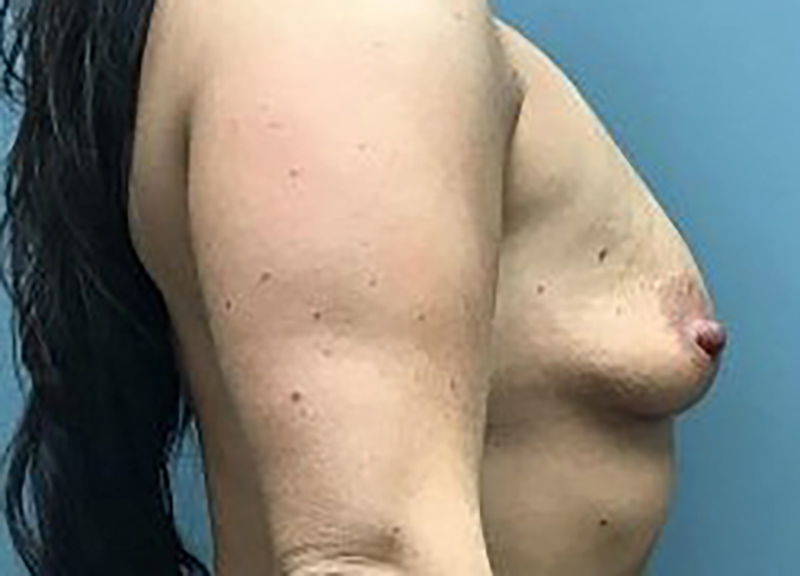 Breast Augmentation before and after - before