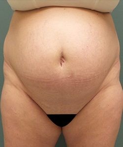 Mommy Makeover before and after - before