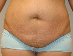 Mommy Makeover before and after - before
