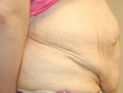 Mommy Makeover before and after - before