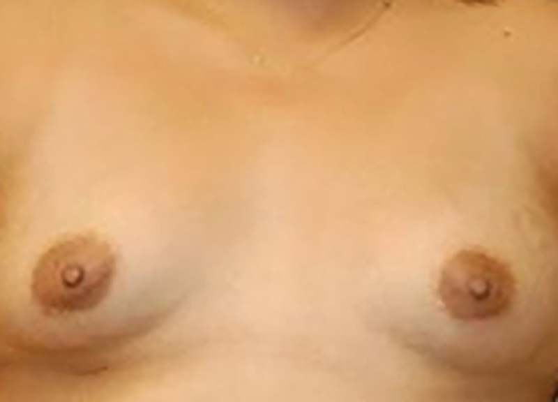 Breast Augmentation before and after - before