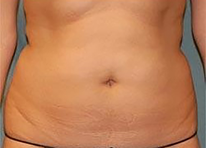 Liposuction before and after - before