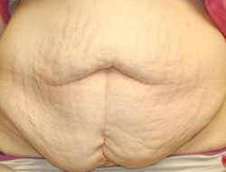 Mommy Makeover before and after - before