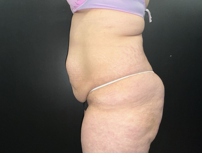 Mommy Makeover before and after - before