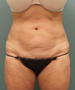 Mommy Makeover before and after - before