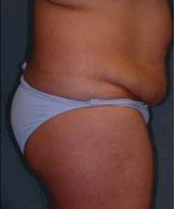 Mommy Makeover before and after - before