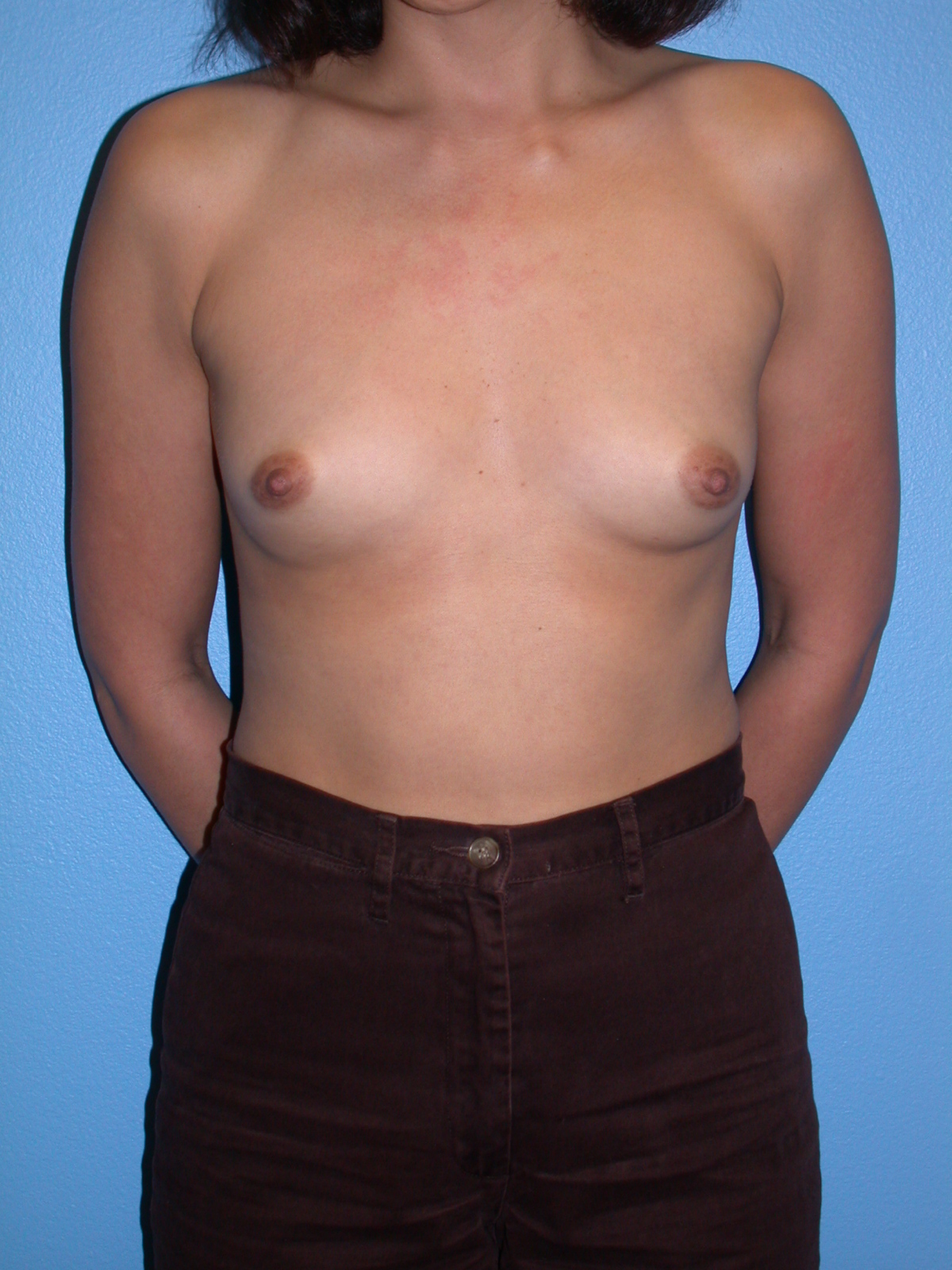 Breast Augmentation by Dr. Douglas Hendricks — before