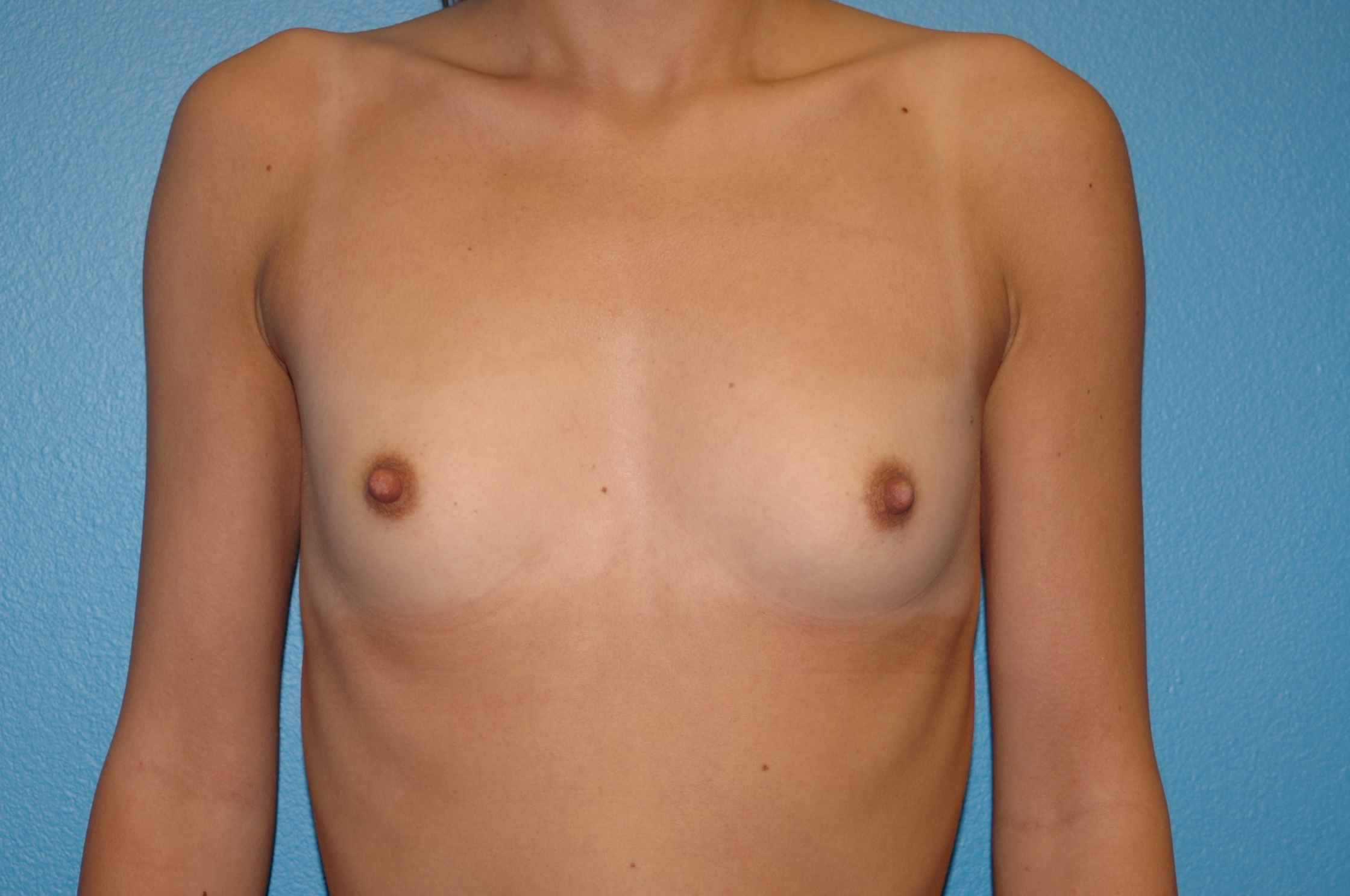 Breast Augmentation by Dr. Douglas Hendricks — before
