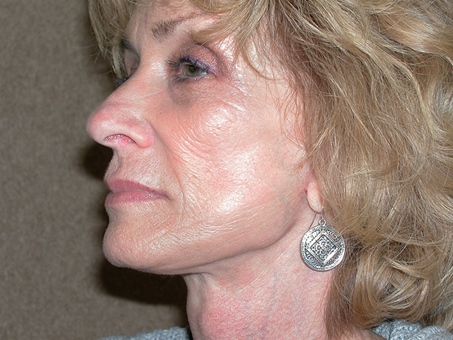 Facelift before and after - after