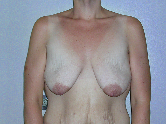 Breast Augmentation before and after - before