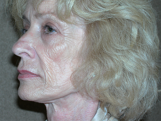 Facelift before and after - before